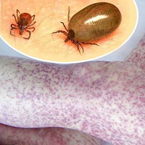 sintomas-rickettiosis